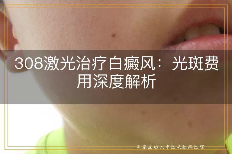308激光治疗白癜风：光斑费用深度解析