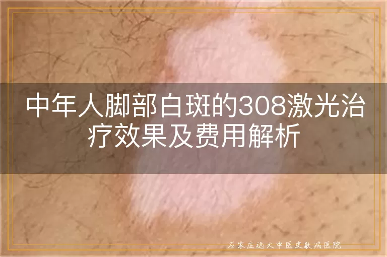 中年人脚部白斑的308激光治疗效果及费用解析