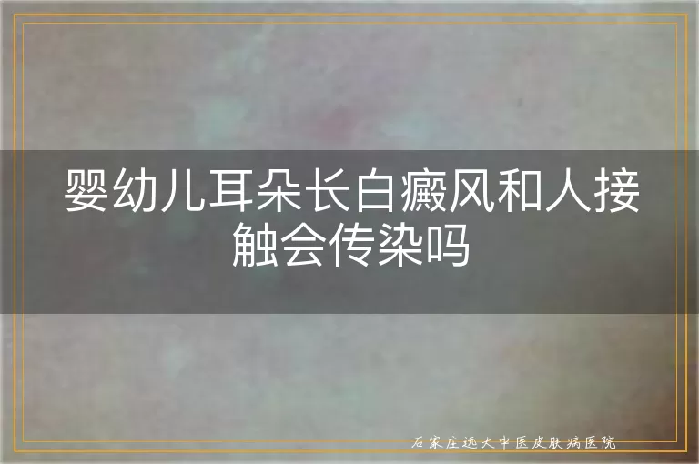 婴幼儿耳朵长白癜风和人接触会传染吗