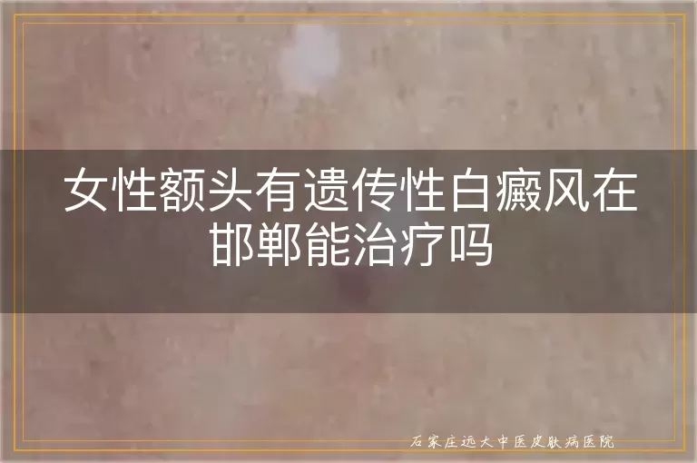 女性额头有遗传性白癜风在邯郸能治疗吗