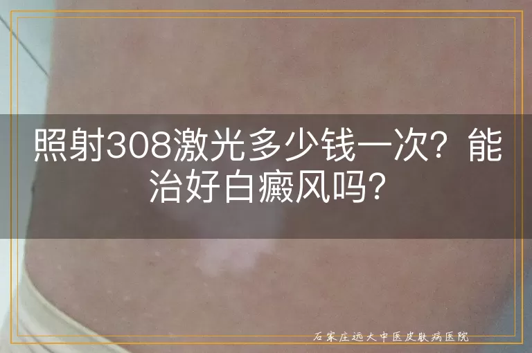 照射308激光多少钱一次？能治好白癜风吗？