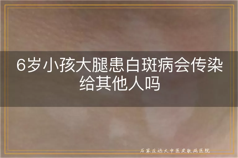 6岁小孩大腿患白斑病会传染给其他人吗