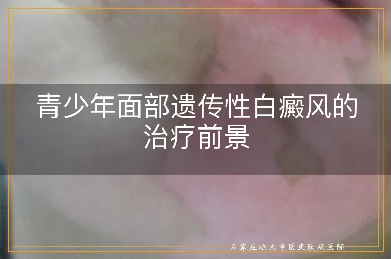 青少年面部遗传性白癜风的治疗前景