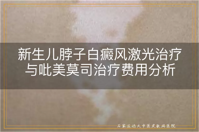 新生儿脖子白癜风激光治疗与吡美莫司治疗费用分析