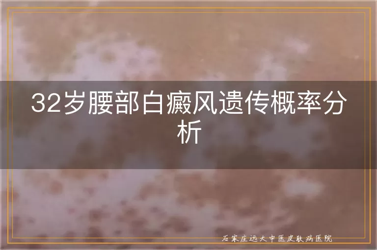 32岁腰部白癜风遗传概率分析