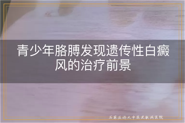 青少年胳膊发现遗传性白癜风的治疗前景