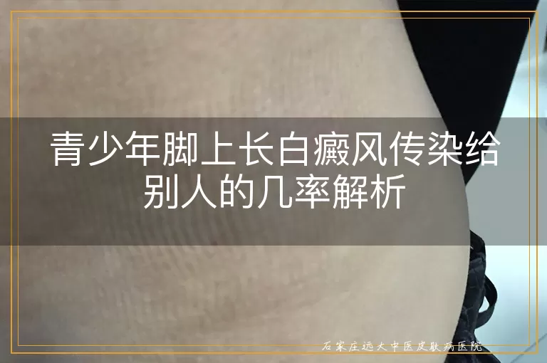 青少年脚上长白癜风传染给别人的几率解析