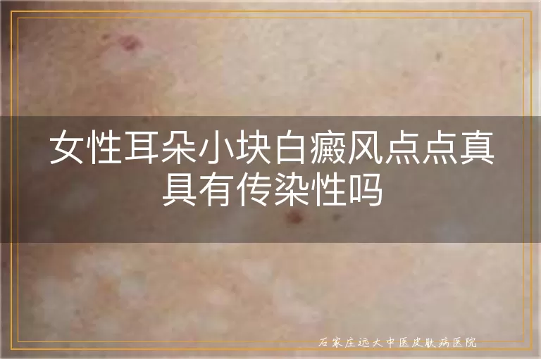 女性耳朵小块白癜风点点真具有传染性吗