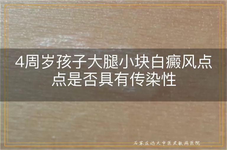 4周岁孩子大腿小块白癜风点点是否具有传染性