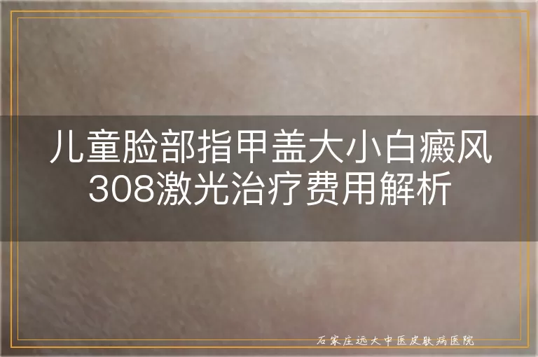 儿童脸部指甲盖大小白癜风308激光治疗费用解析