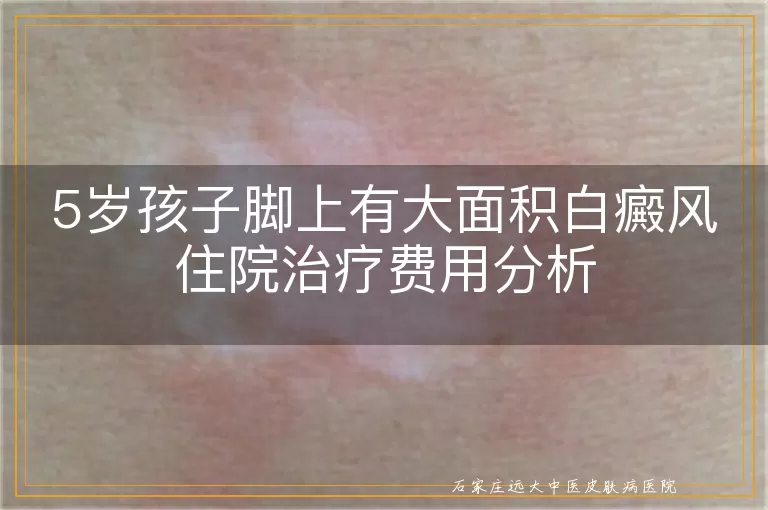 5岁孩子脚上有大面积白癜风住院治疗费用分析