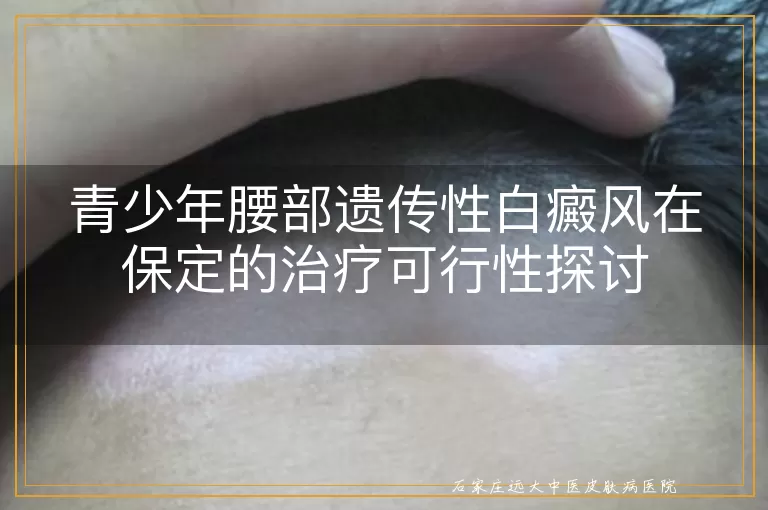 青少年腰部遗传性白癜风在保定的治疗可行性探讨