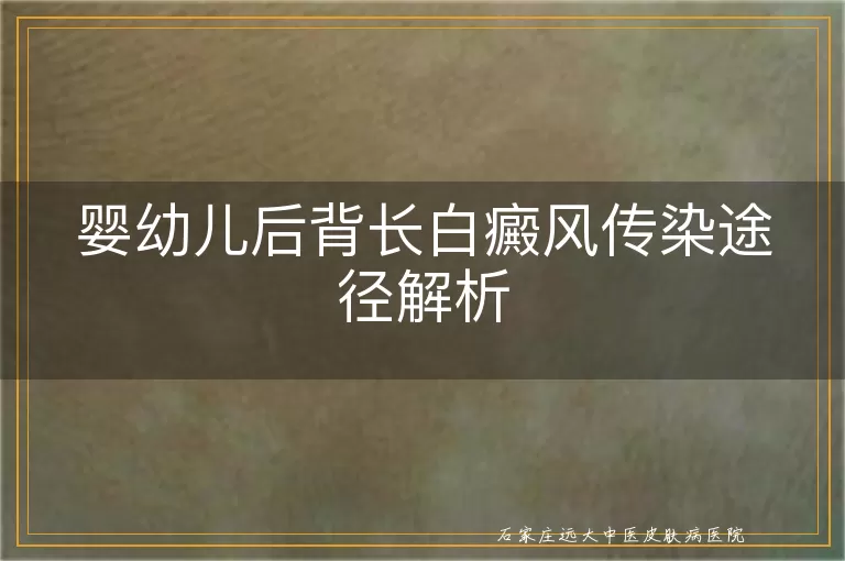 婴幼儿后背长白癜风传染途径解析