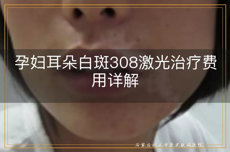 孕妇耳朵白斑308激光治疗费用详解
