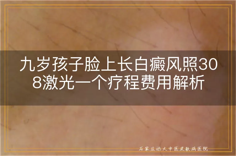 九岁孩子脸上长白癜风照308激光一个疗程费用解析