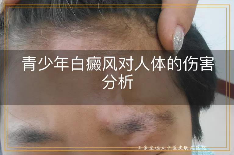 青少年白癜风对人体的伤害分析