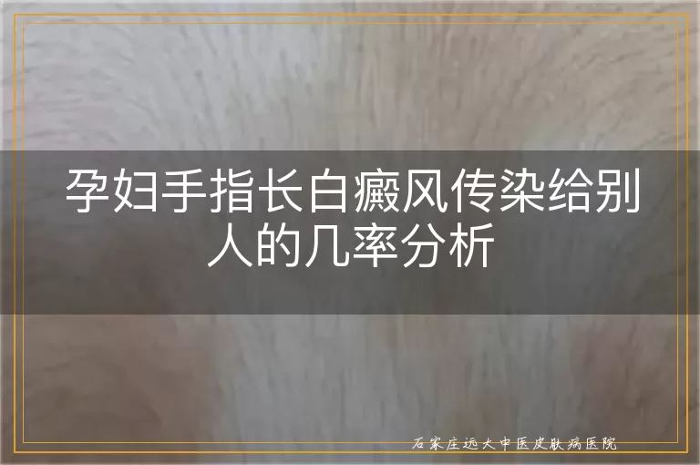 孕妇手指长白癜风传染给别人的几率分析