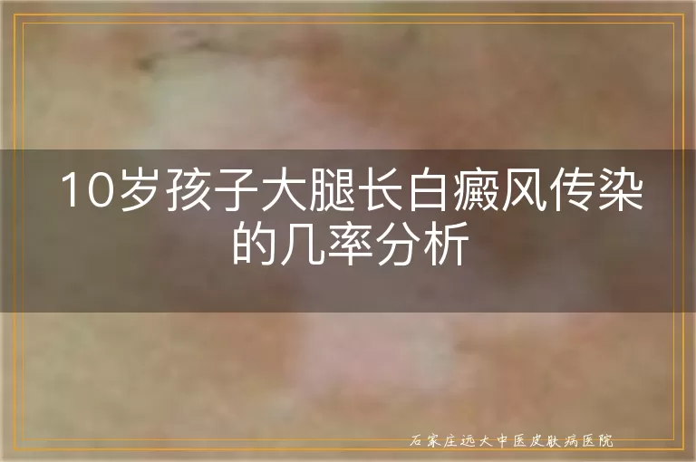 10岁孩子大腿长白癜风传染的几率分析