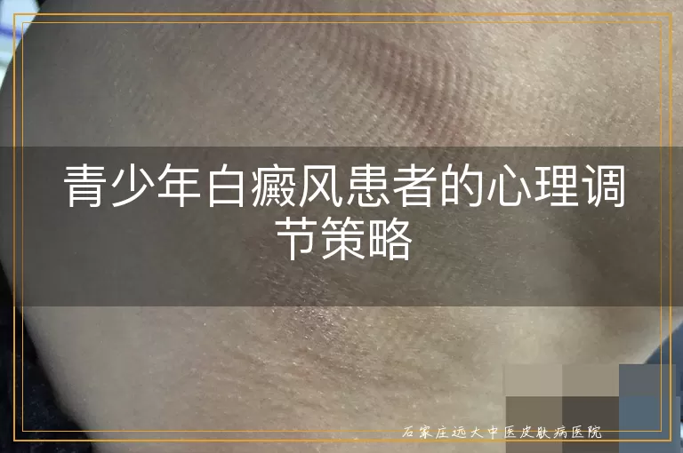 青少年白癜风患者的心理调节策略