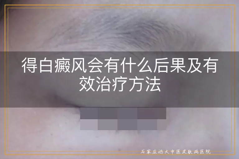 得白癜风会有什么后果及有效治疗方法