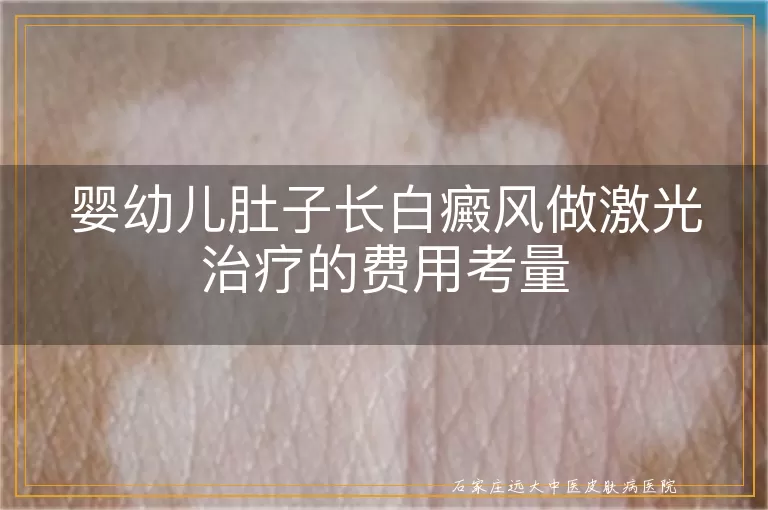婴幼儿肚子长白癜风做激光治疗的费用考量