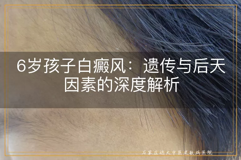 6岁孩子白癜风：遗传与后天因素的深度解析