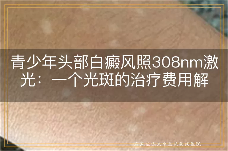 青少年头部白癜风照308nm激光：一个光斑的治疗费用解析