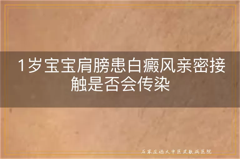 1岁宝宝肩膀患白癜风亲密接触是否会传染