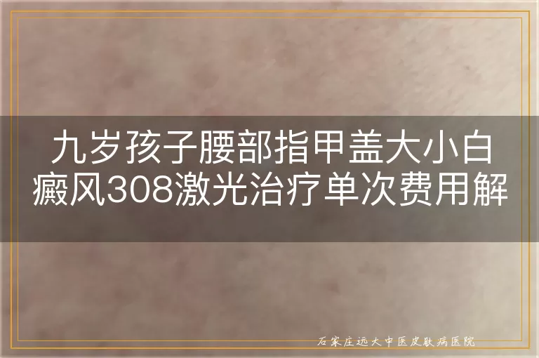 九岁孩子腰部指甲盖大小白癜风308激光治疗单次费用解析