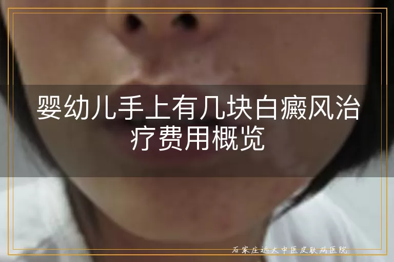 婴幼儿手上有几块白癜风治疗费用概览