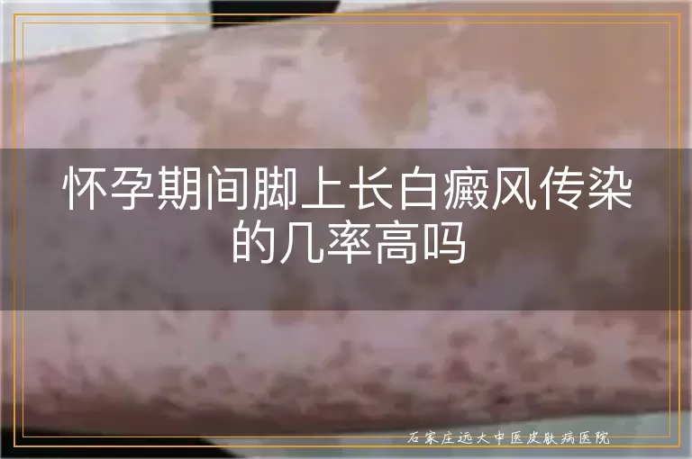 怀孕期间脚上长白癜风传染的几率高吗