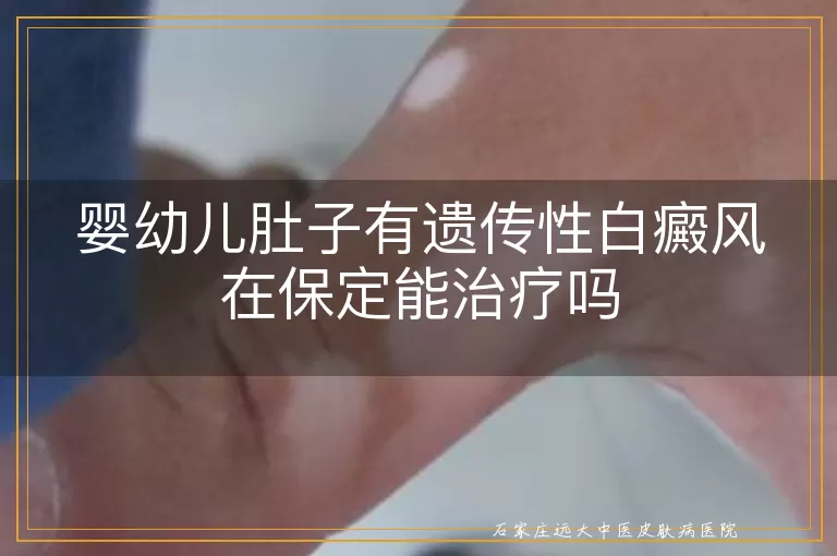 婴幼儿肚子有遗传性白癜风在保定能治疗吗