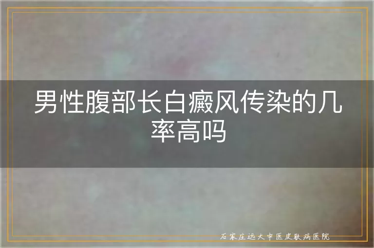 男性腹部长白癜风传染的几率高吗