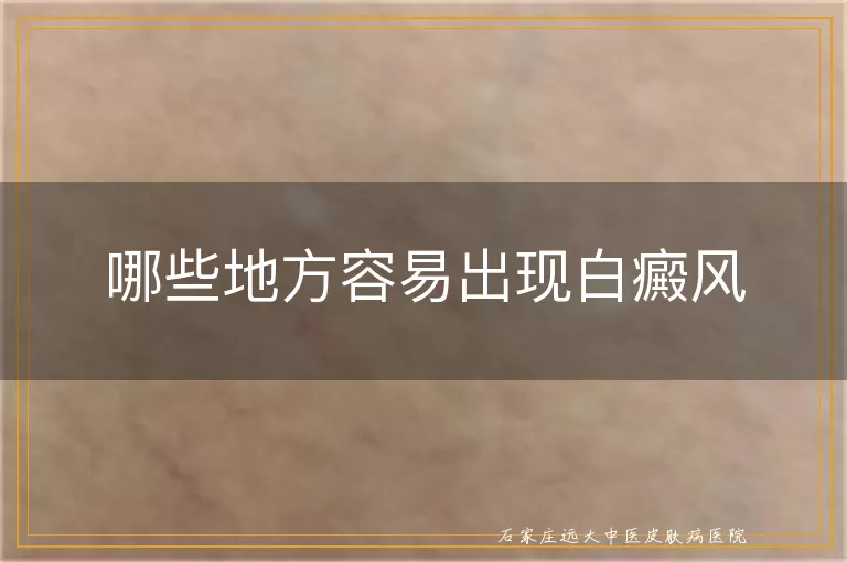 哪些地方容易出现白癜风