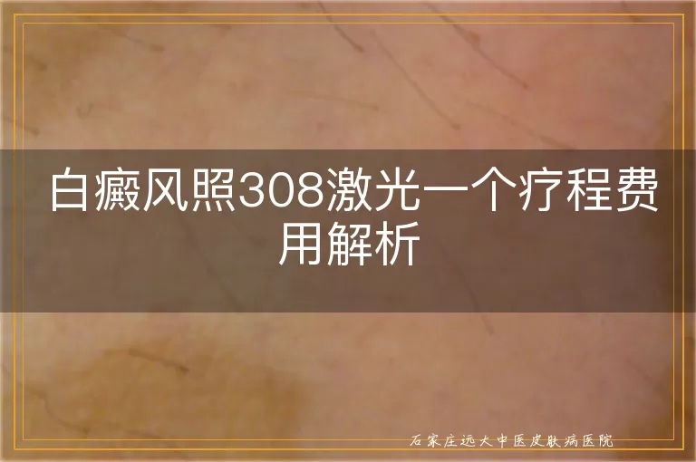 白癜风照308激光一个疗程费用解析