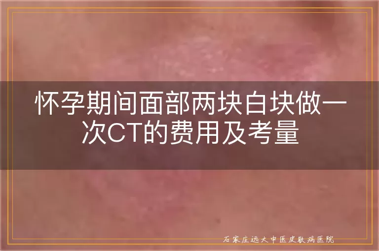 怀孕期间面部两块白块做一次CT的费用及考量