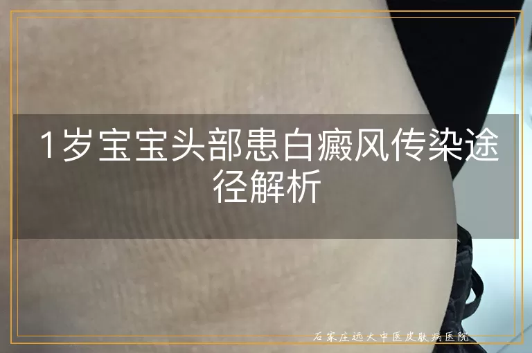 1岁宝宝头部患白癜风传染途径解析