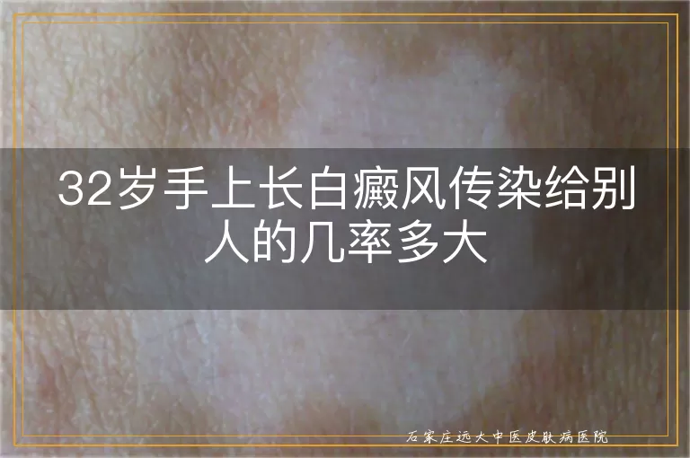 32岁手上长白癜风传染给别人的几率多大