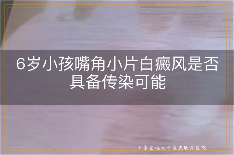 6岁小孩嘴角小片白癜风是否具备传染可能