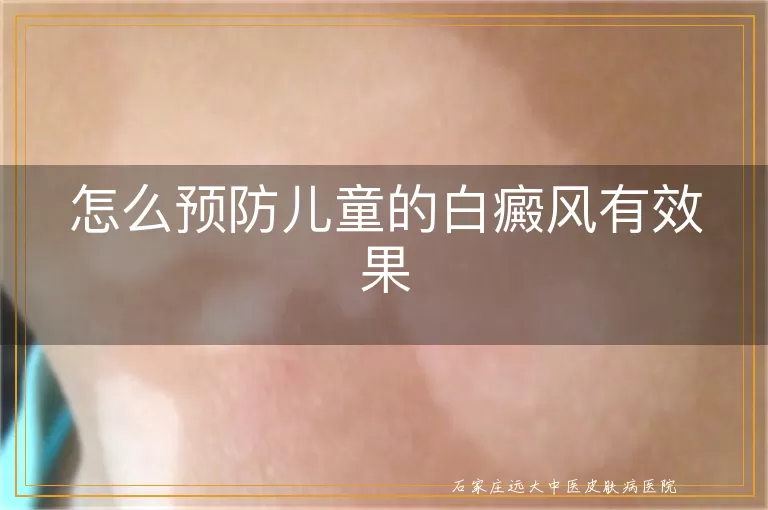 怎么预防儿童的白癜风有效果