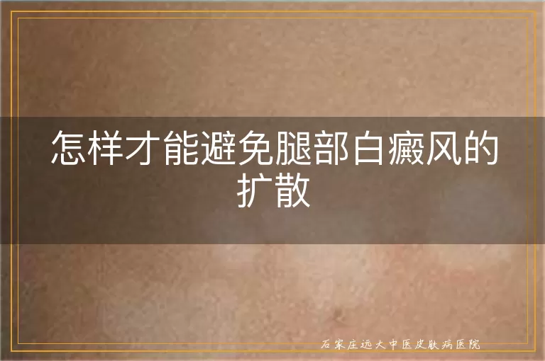 怎样才能避免腿部白癜风的扩散