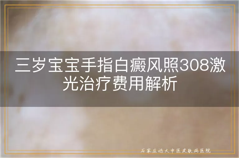 三岁宝宝手指白癜风照308激光治疗费用解析