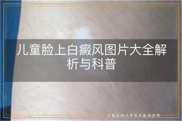 儿童脸上白癜风图片大全解析与科普