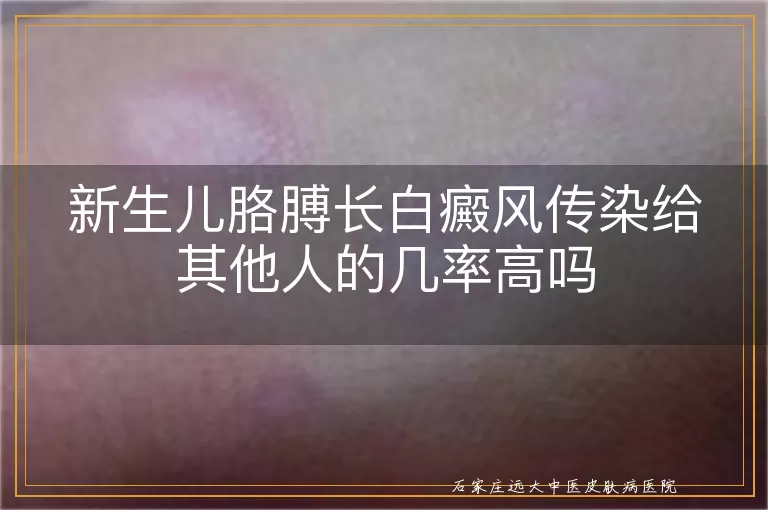 新生儿胳膊长白癜风传染给其他人的几率高吗
