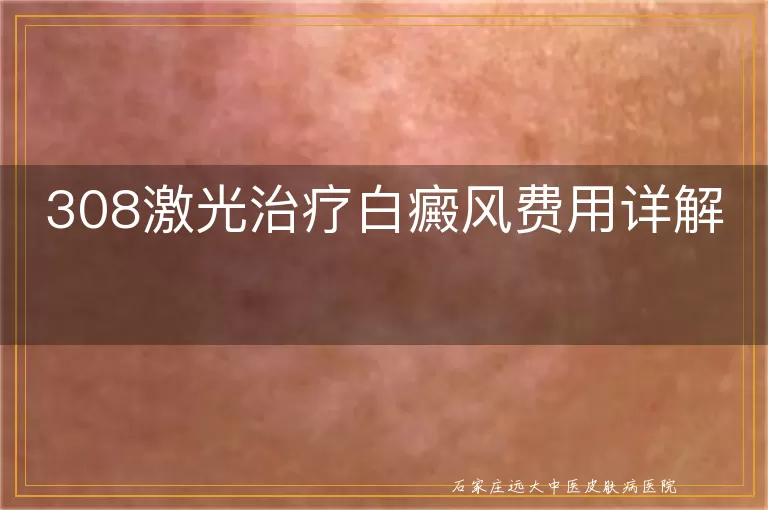 308激光治疗白癜风费用详解