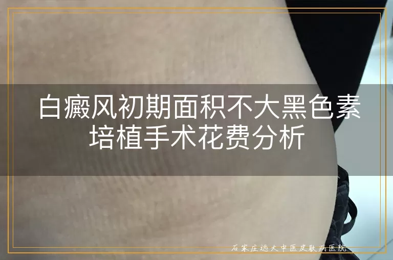 白癜风初期面积不大黑色素培植手术花费分析