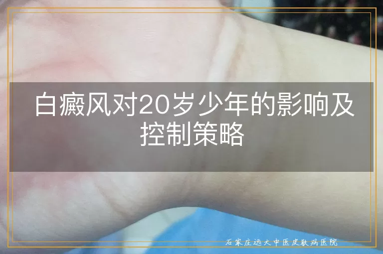 白癜风对20岁少年的影响及控制策略