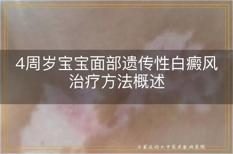 4周岁宝宝面部遗传性白癜风治疗方法概述