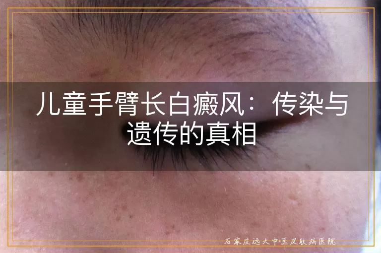 儿童手臂长白癜风：传染与遗传的真相