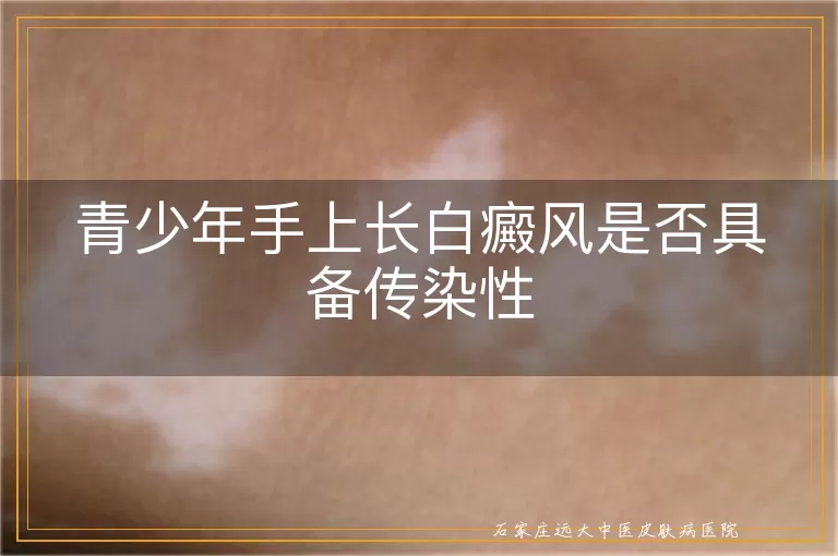 青少年手上长白癜风是否具备传染性